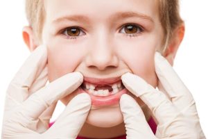 How to Prevent Tooth Decay at Any Age